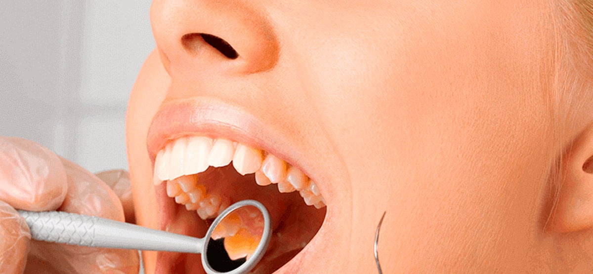 Zahnerosion: Ursache & Behandlung