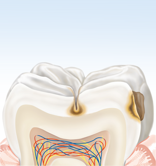 Ohne verbesserte und geeignete Mundhygienemaßnahmen