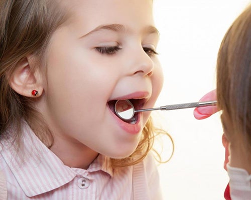 Kariesvorbeugung durch Fluoride